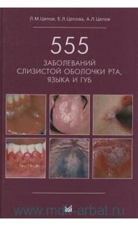 555 захворювань слизової оболонки рота, язика і губ. - фото 1