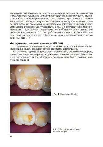Современные пломбировочные материалы в клинической стоматологии - фото 3