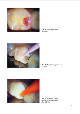 Современные пломбировочные материалы в клинической стоматологии - фото 4