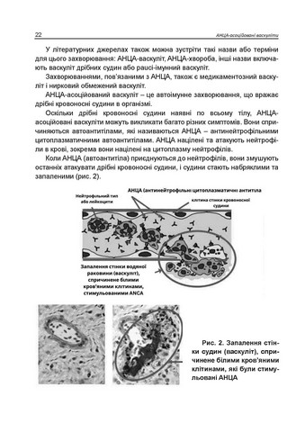 АНЦА-асоційовані васкуліти. Катеренчук І.П., Гуцаленко O.O., Ярмола T.І. - фото 7